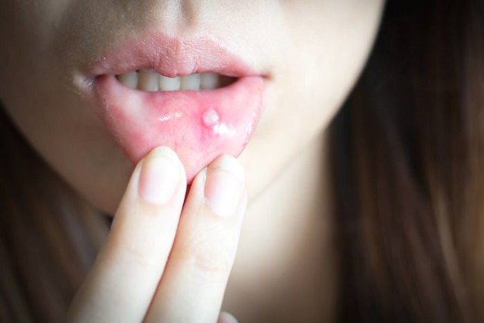 Obat Alami yang Ampuh Sembuhkan Sariawan