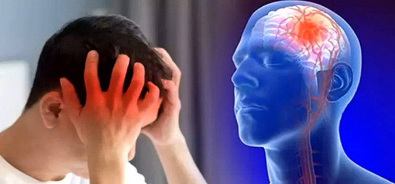 Waspada Gejala Stroke pada Usia Muda